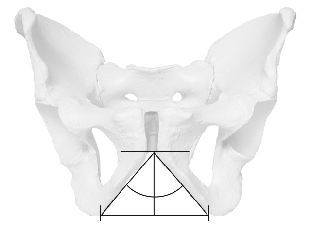 Male pelvis with steep pubic skids.