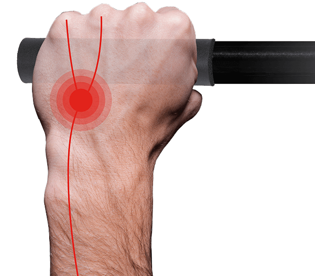 Der Ulnarnerv ist auf einer Hand eingezeichnet. Ein roter Punkt signalisiert die starke Belastung des Nerves.